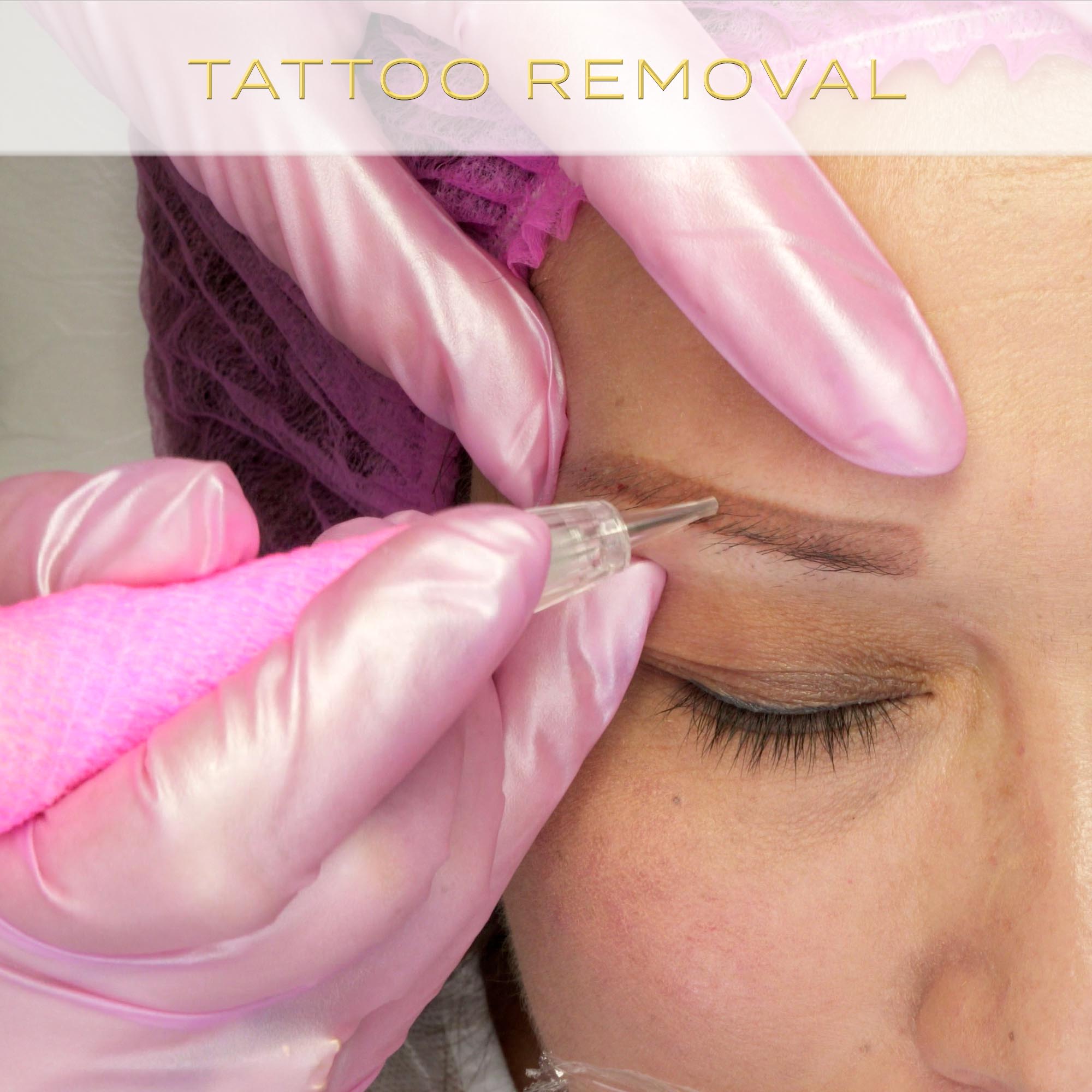 Tattoo Removal Online Course